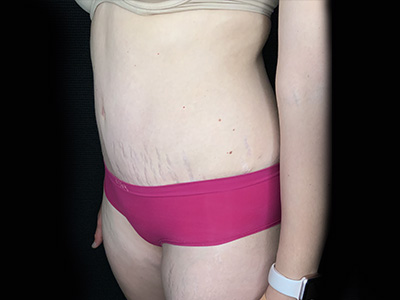 Patient #31151: Tummy Tuck After Image