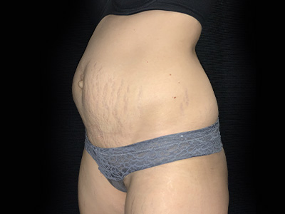 Patient #31151: Tummy Tuck Before Image