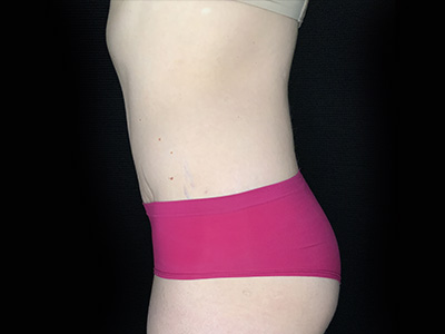 Patient #31151: Tummy Tuck After Image