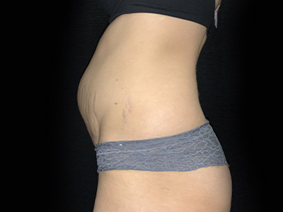 Patient #31151: Tummy Tuck Before Image