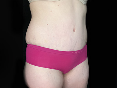 Patient #31151: Tummy Tuck After Image