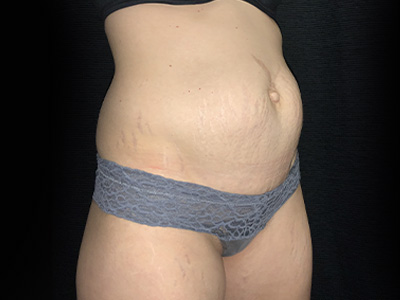 Patient #31151: Tummy Tuck Before Image