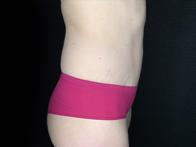 Patient #31151: Tummy Tuck After Image
