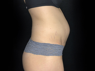 Patient #31151: Tummy Tuck Before Image