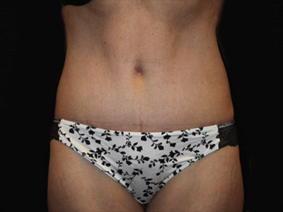 Patient #34110: Tummy Tuck After Image