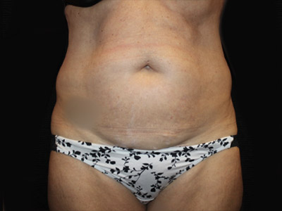 Patient #34110: Tummy Tuck Before Image