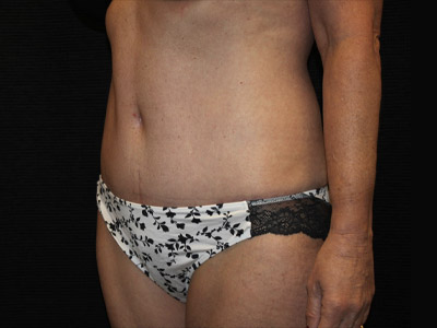 Patient #34110: Tummy Tuck After Image