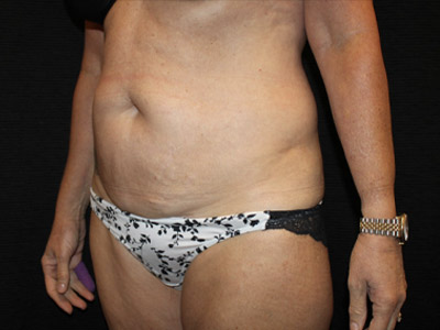 Patient #34110: Tummy Tuck Before Image