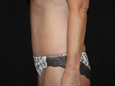 Patient #34110: Tummy Tuck After Image