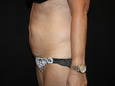 Patient #34110: Tummy Tuck Before Image