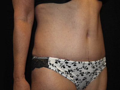 Patient #34110: Tummy Tuck After Image