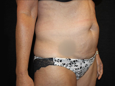Patient #34110: Tummy Tuck Before Image