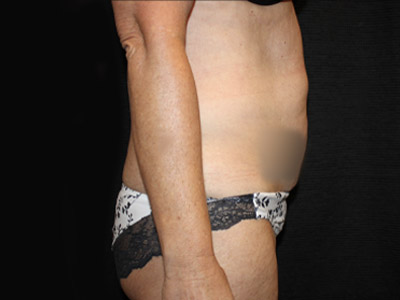 Patient #34110: Tummy Tuck Before Image