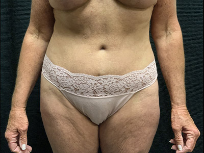 Patient #38510: Tummy Tuck After Image
