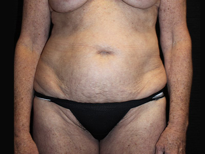 Patient #38510: Tummy Tuck Before Image