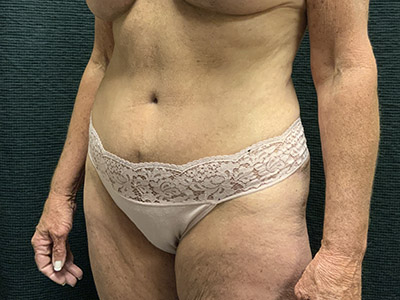 Patient #38510: Tummy Tuck After Image