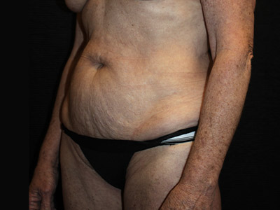 Patient #38510: Tummy Tuck Before Image