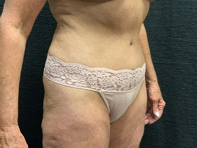 Patient #38510: Tummy Tuck After Image