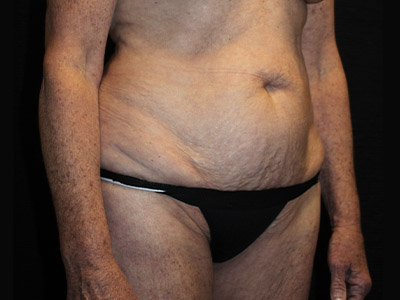 Patient #38510: Tummy Tuck Before Image