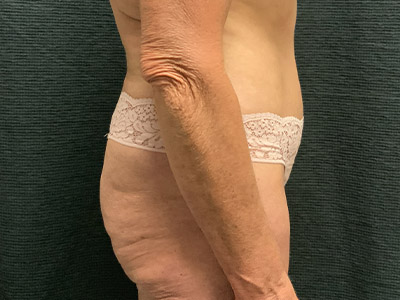 Patient #38510: Tummy Tuck After Image