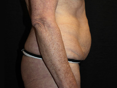 Patient #38510: Tummy Tuck Before Image