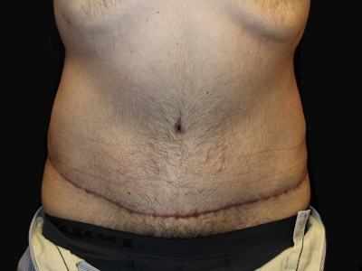 Patient #42664: Tummy Tuck with Liposuction After Image