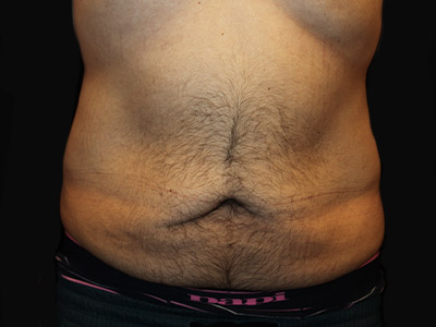 Patient #42664: Tummy Tuck with Liposuction Before Image