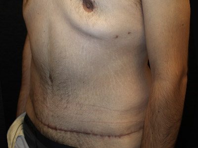 Patient #42664: Tummy Tuck with Liposuction After Image