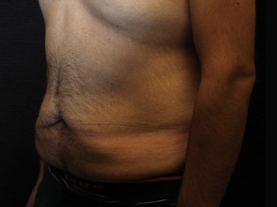 Patient #42664: Tummy Tuck with Liposuction Before Image