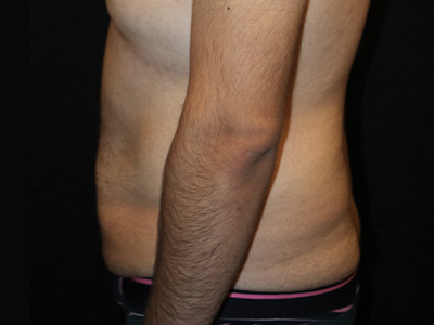 Patient #42664: Tummy Tuck with Liposuction Before Image
