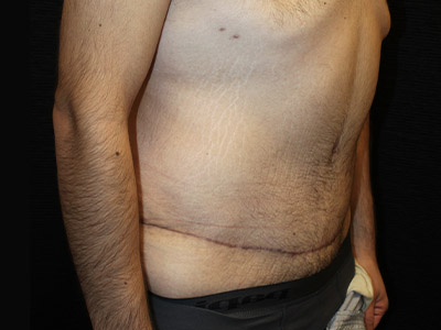 Patient #42664: Tummy Tuck with Liposuction After Image