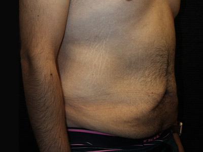 Patient #42664: Tummy Tuck with Liposuction Before Image