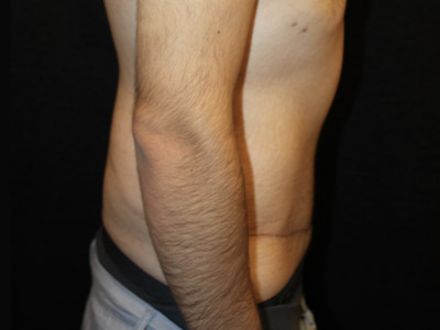 Patient #42664: Tummy Tuck with Liposuction After Image