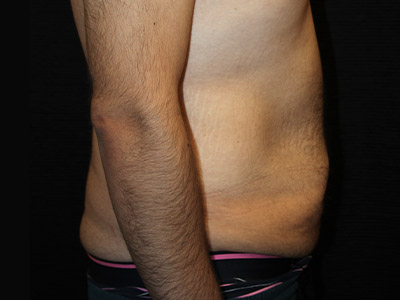 Patient #42664: Tummy Tuck with Liposuction Before Image