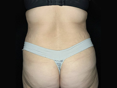 Patient #46024: Tummy Tuck with Liposuction After Image