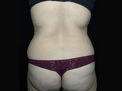 Patient #46024: Tummy Tuck with Liposuction Before Image
