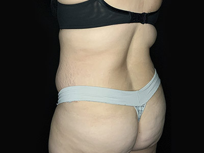 Patient #46024: Tummy Tuck with Liposuction After Image