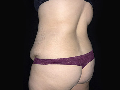 Patient #46024: Tummy Tuck with Liposuction Before Image