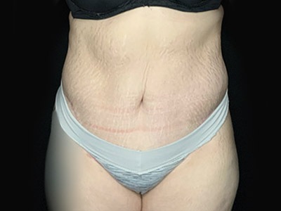 Patient #46024: Tummy Tuck with Liposuction After Image