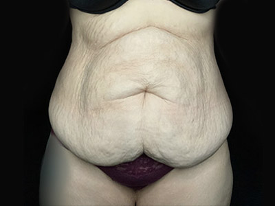 Patient #46024: Tummy Tuck with Liposuction Before Image