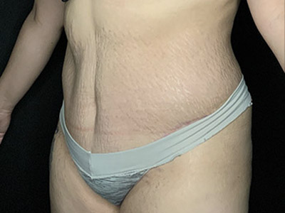 Patient #46024: Tummy Tuck with Liposuction After Image