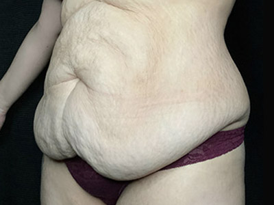 Patient #46024: Tummy Tuck with Liposuction Before Image