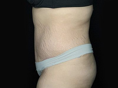 Patient #46024: Tummy Tuck with Liposuction After Image