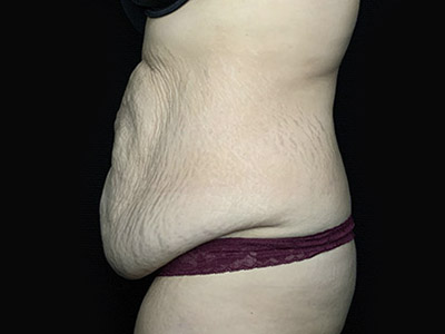 Patient #46024: Tummy Tuck with Liposuction Before Image
