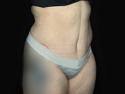 Patient #46024: Tummy Tuck with Liposuction After Image