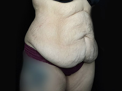 Patient #46024: Tummy Tuck with Liposuction Before Image