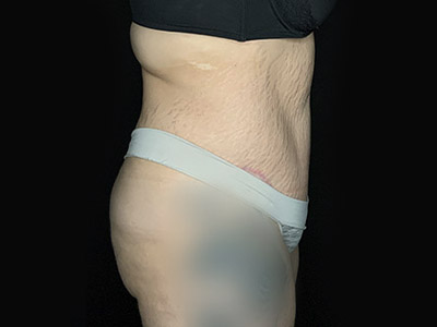 Patient #46024: Tummy Tuck with Liposuction After Image