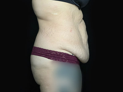 Patient #46024: Tummy Tuck with Liposuction Before Image