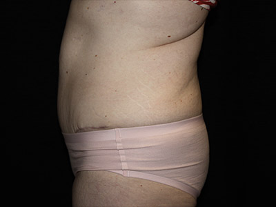 Patient #48145: Tummy Tuck After Image
