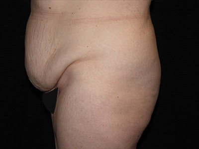 Patient #48145: Tummy Tuck Before Image